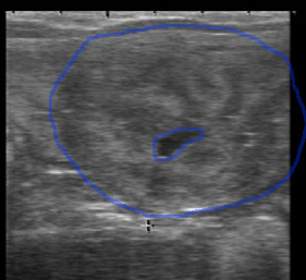 ultrasound of estrual uterus with normal fluid