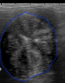 ultrasound of normal estrual uterus with edema