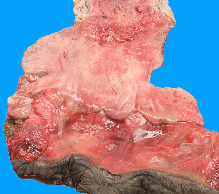 posterior vagina