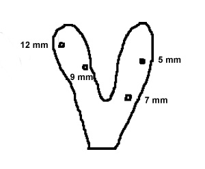 line drawing of a map of where cysts occur in a mare's uterus with the size of the cysts: 4 cysts 5-12 mm