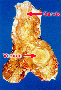day 18 vesicle and uterus