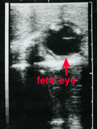 ultrasound image of fetal eye