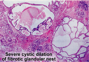 Severe cystic dilation of fibrotic  glandular nest