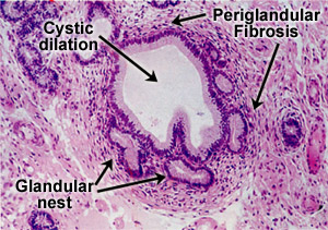 histology of cystic dilation and periglandular fibrosis